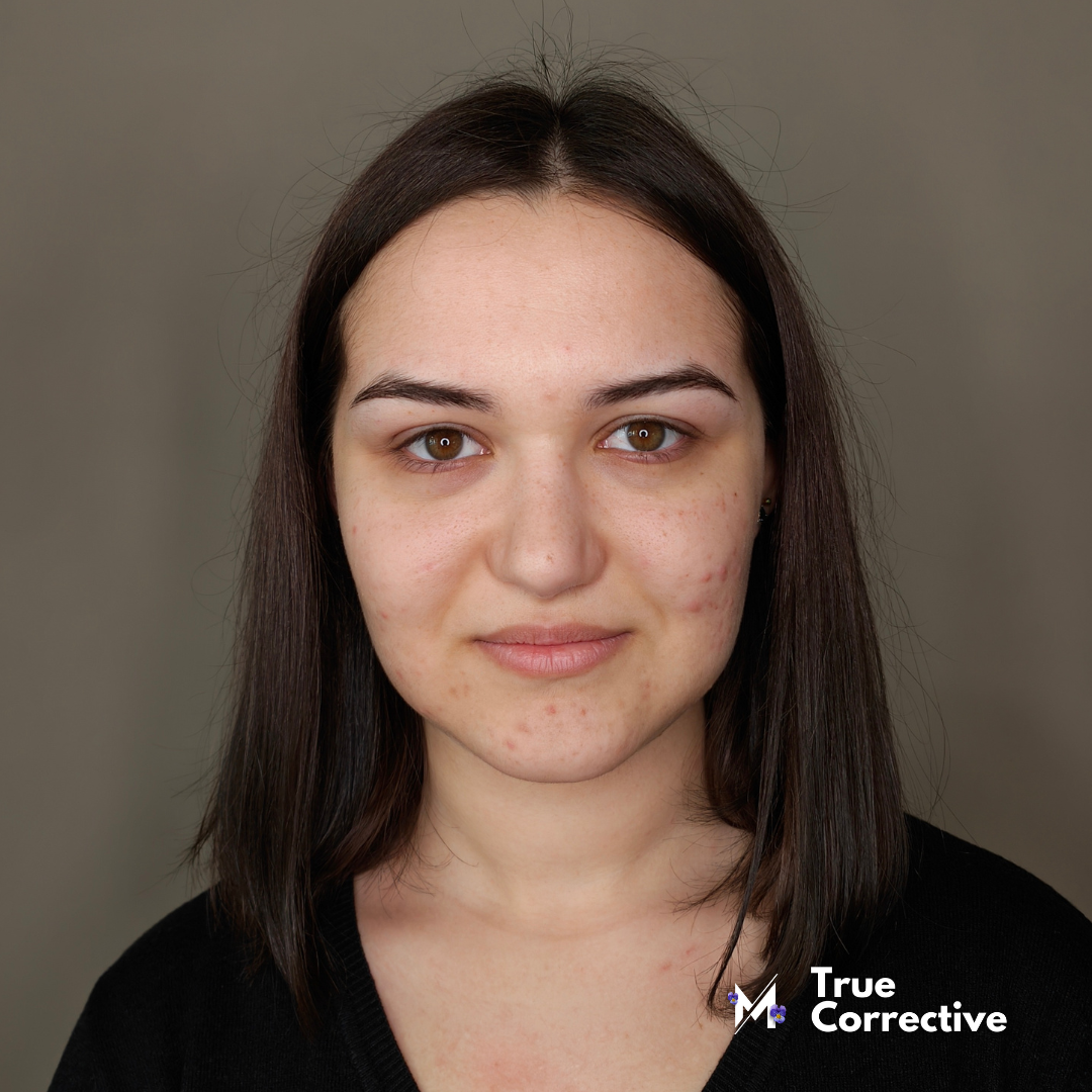 True Corrective - Corso Make Up Online copertura Acne e Imperfezioni in Cream e Gel Technique